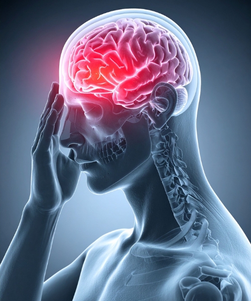 TMS Therapy for Migraines