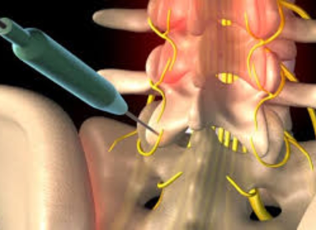 Spinal Cord Stimulation